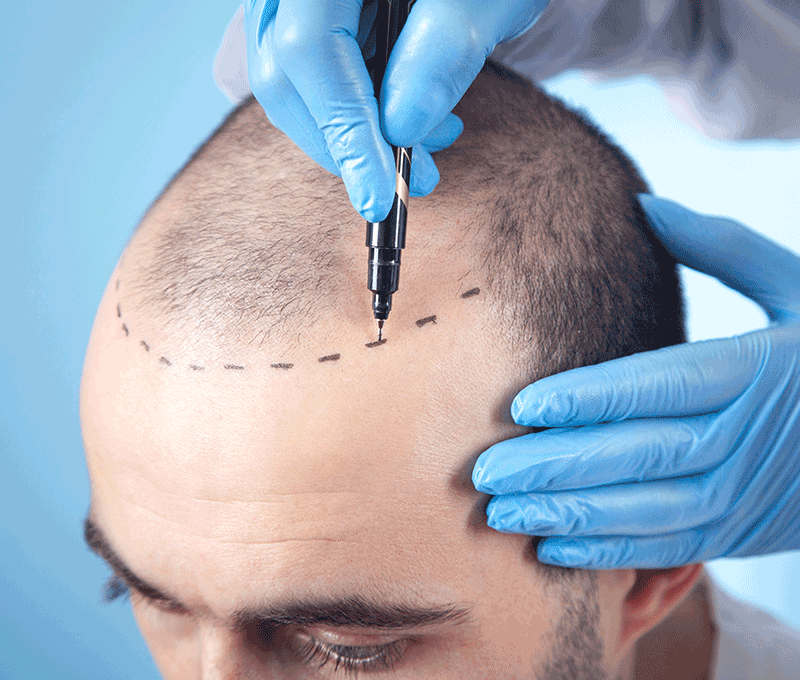 5 Best Hair Transplant Clinic in Islamabad